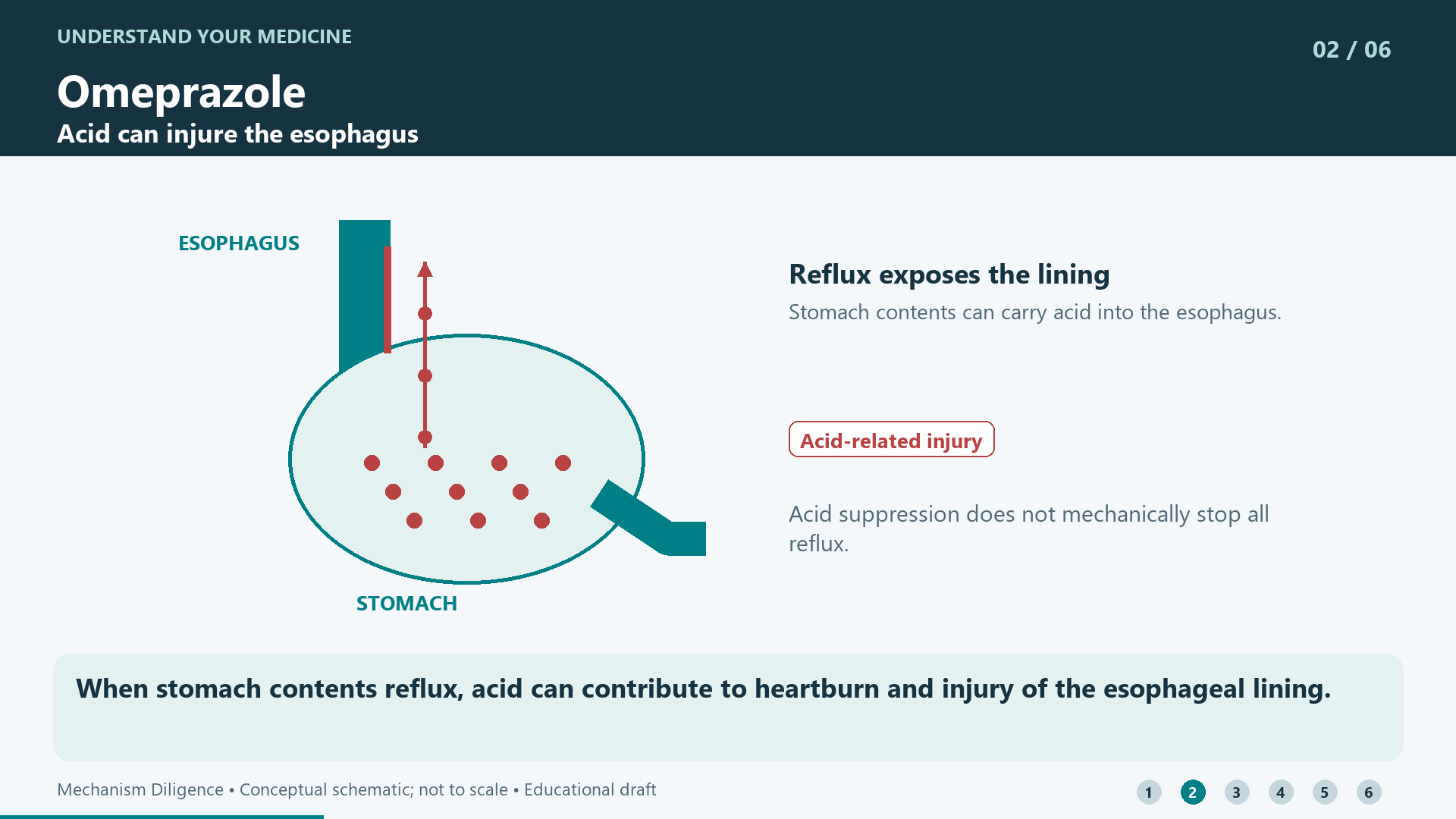 When stomach contents reflux, acid can contribute to heartburn and injury of the esophageal lining.